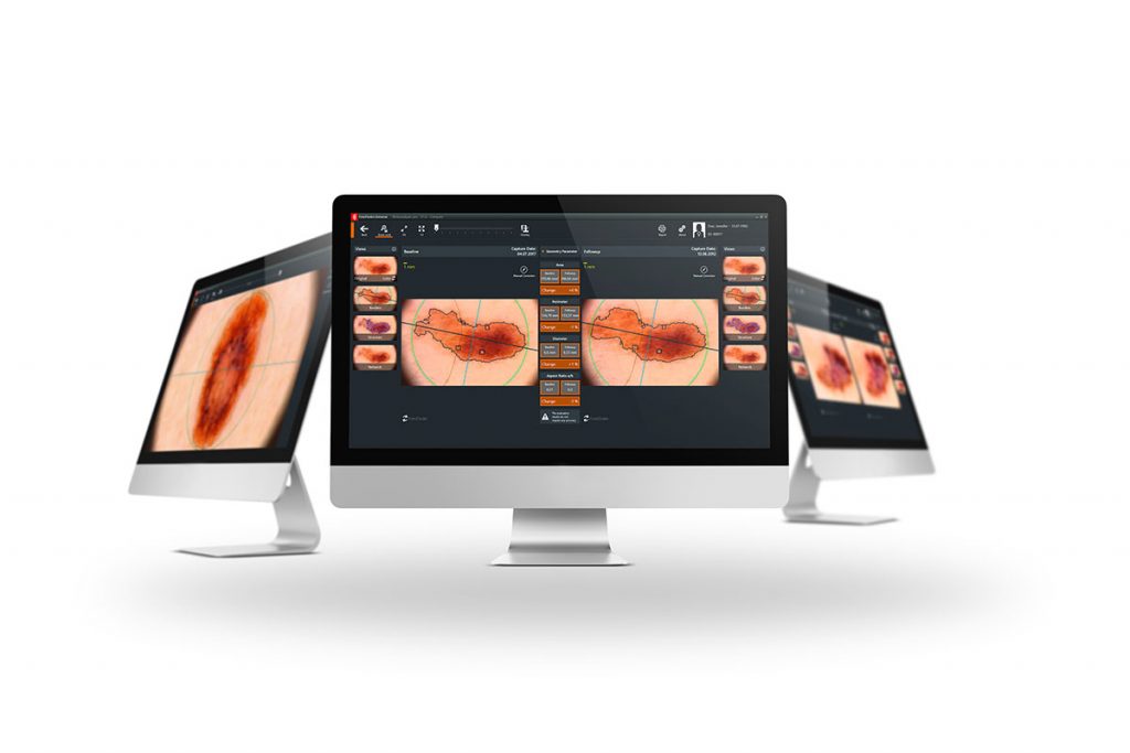 Skin cancer screening with Fotofinder